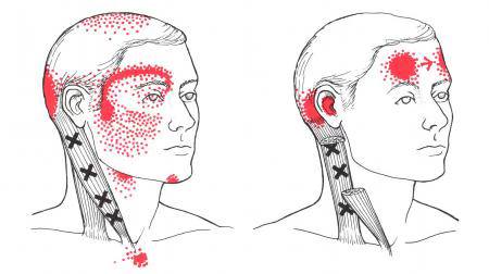 Diagram showing SCM muscle trigger points and referred pain areas on the head and face, including around the eye, ear, forehead, and jaw.