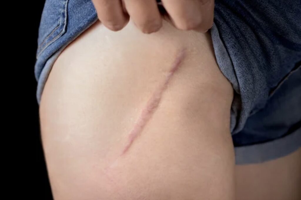 Testimonial: Post-Surgical Recovery Scar After Hip Replacement Healed hip replacement surgery testimonial following Dena Denali's Surgical Preparation and Rehabilitation massage protocols