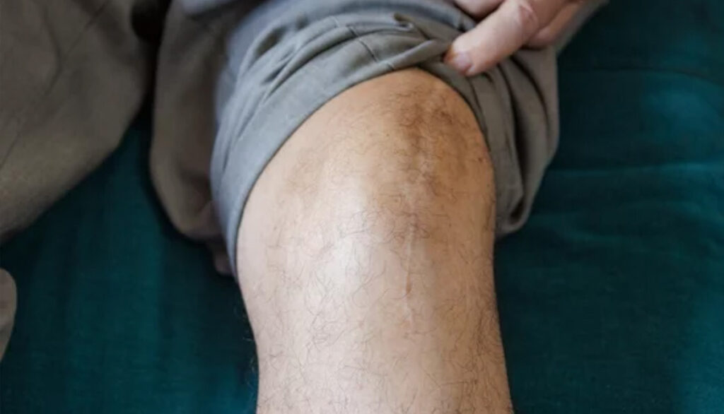 Testimonial: Knee Replacement Recovery at Body Kneads Testimonial success story shared by Dena Denali's patient after a total knee replacement.