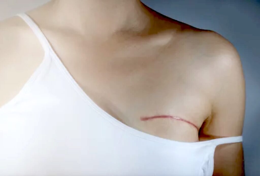 Testimonial: Post-Mastectomy Recovery Support with Dena Denali Testimonial: Post-Mastectomy Recovery Support with Dena Denali